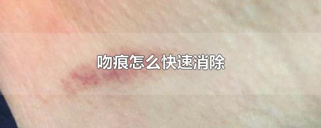 吻痕怎么快速消除